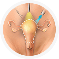 Laparoscopic Surgery